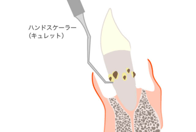 ハンドスケーラー（キュレット）