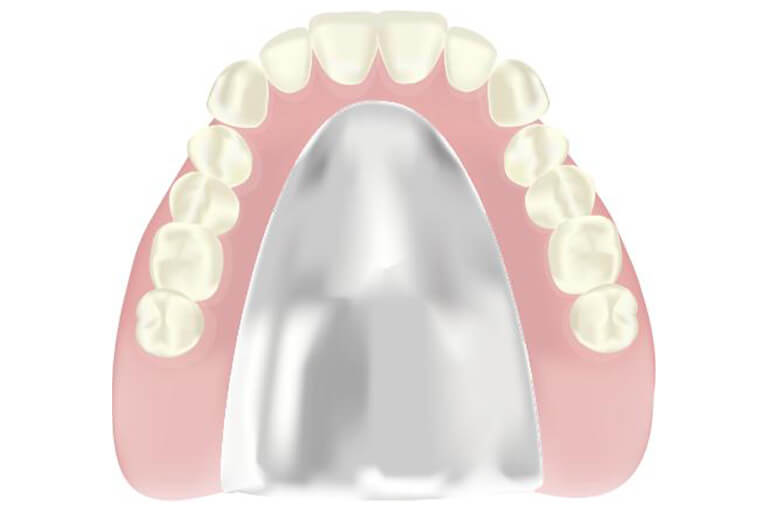 コバルトクロム床義歯