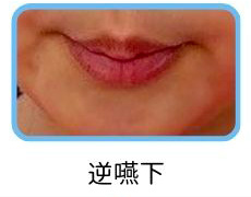 逆嚥下